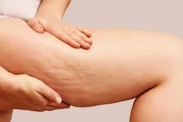 Image of woman showing leg with cellulite Aldridge
