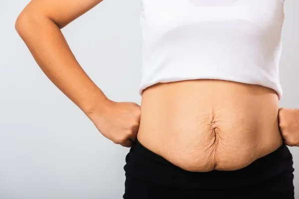 Image of a woman's stomach after weight loss with sagging skin following a gastric band Aldridge