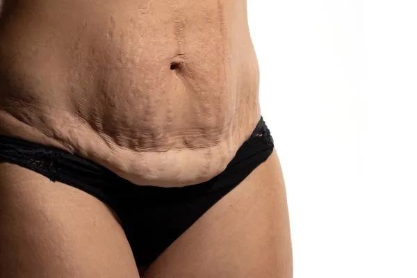 Image of womans stomach after weight loss injections Aldridge showing saggy skin